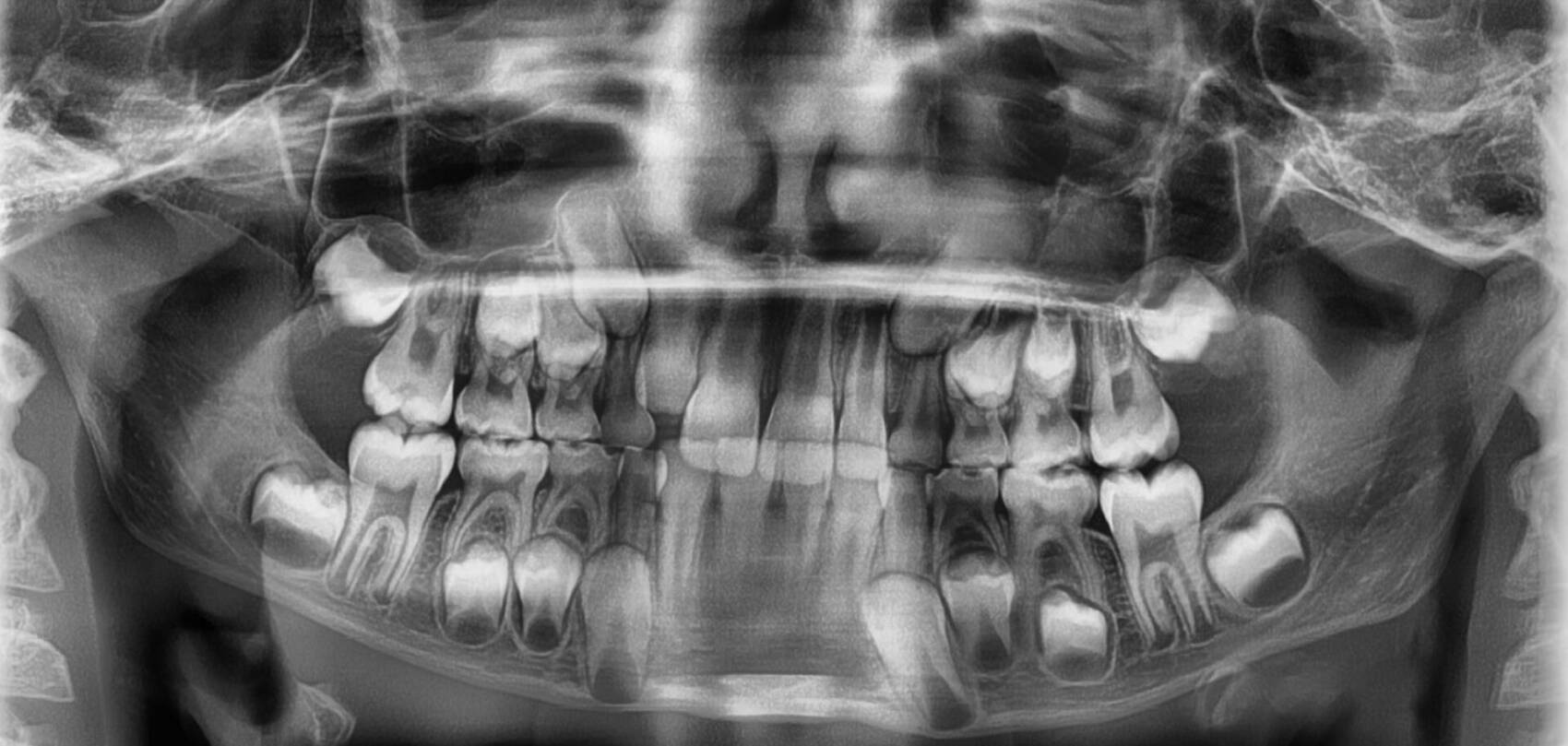 Radio de la dentition d'un enfant présentant la danse des dents de lait avec les dents définitives qui se préparent. Les Chicos de France
